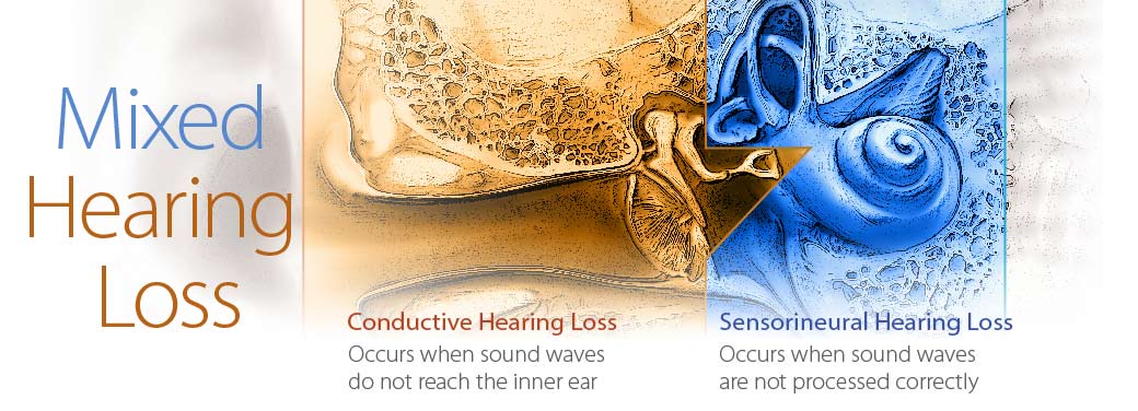 Mixed Hearing Loss | North State Audiological Services